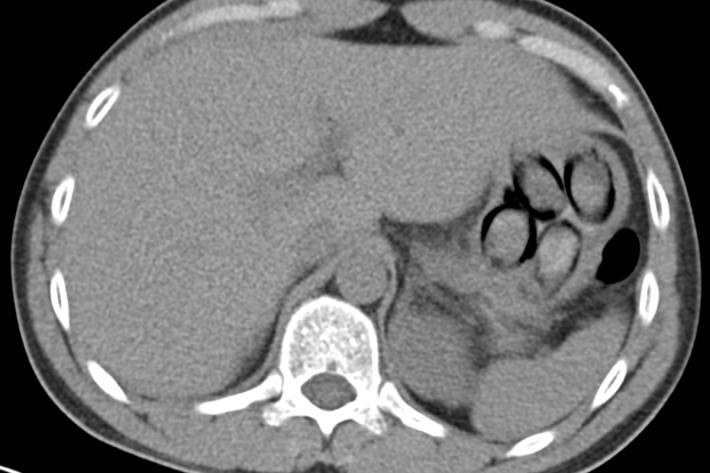 Die Röntgenaufnahme zeigt deutlich die verschluckten Päckchen.