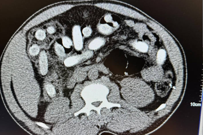 Die radiologische Untersuchung bestätigte den Verdacht.
