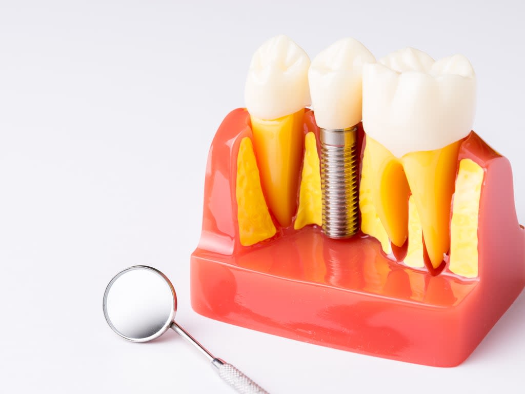 coupe d'une gencive avec implant dentaire
