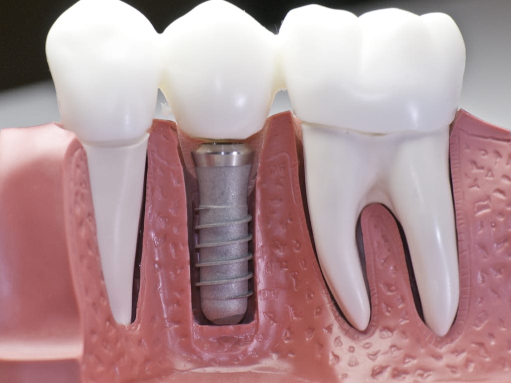 coupe machoire avec implant dentaire