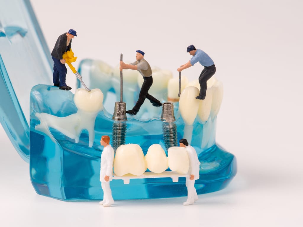 illustration pose bridge sur implants