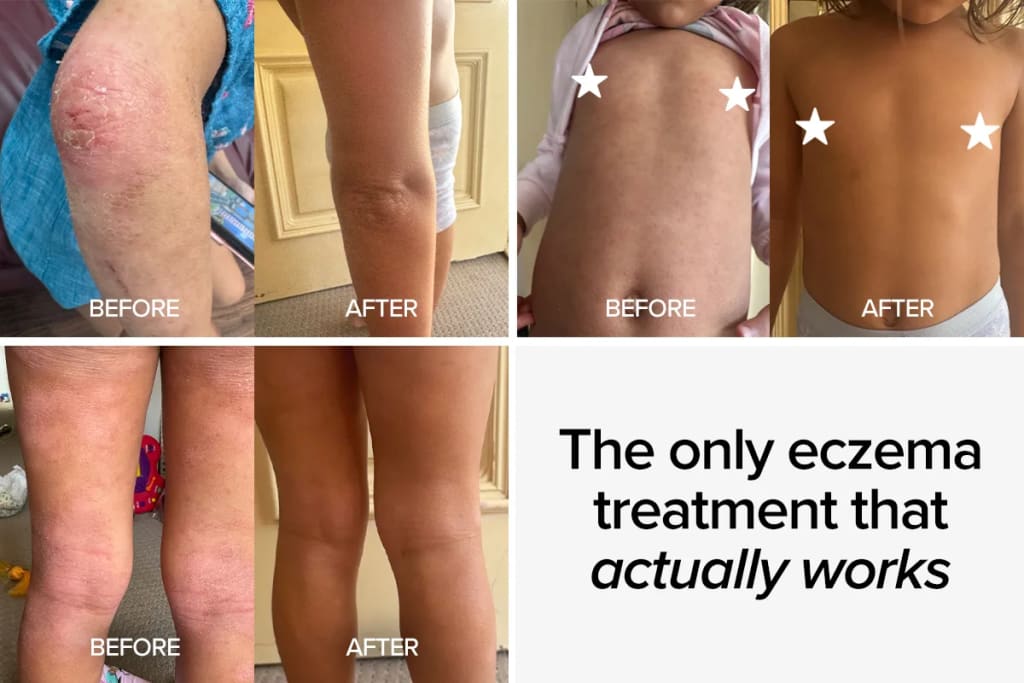 Multiple before and after images showing significant eczema improvement