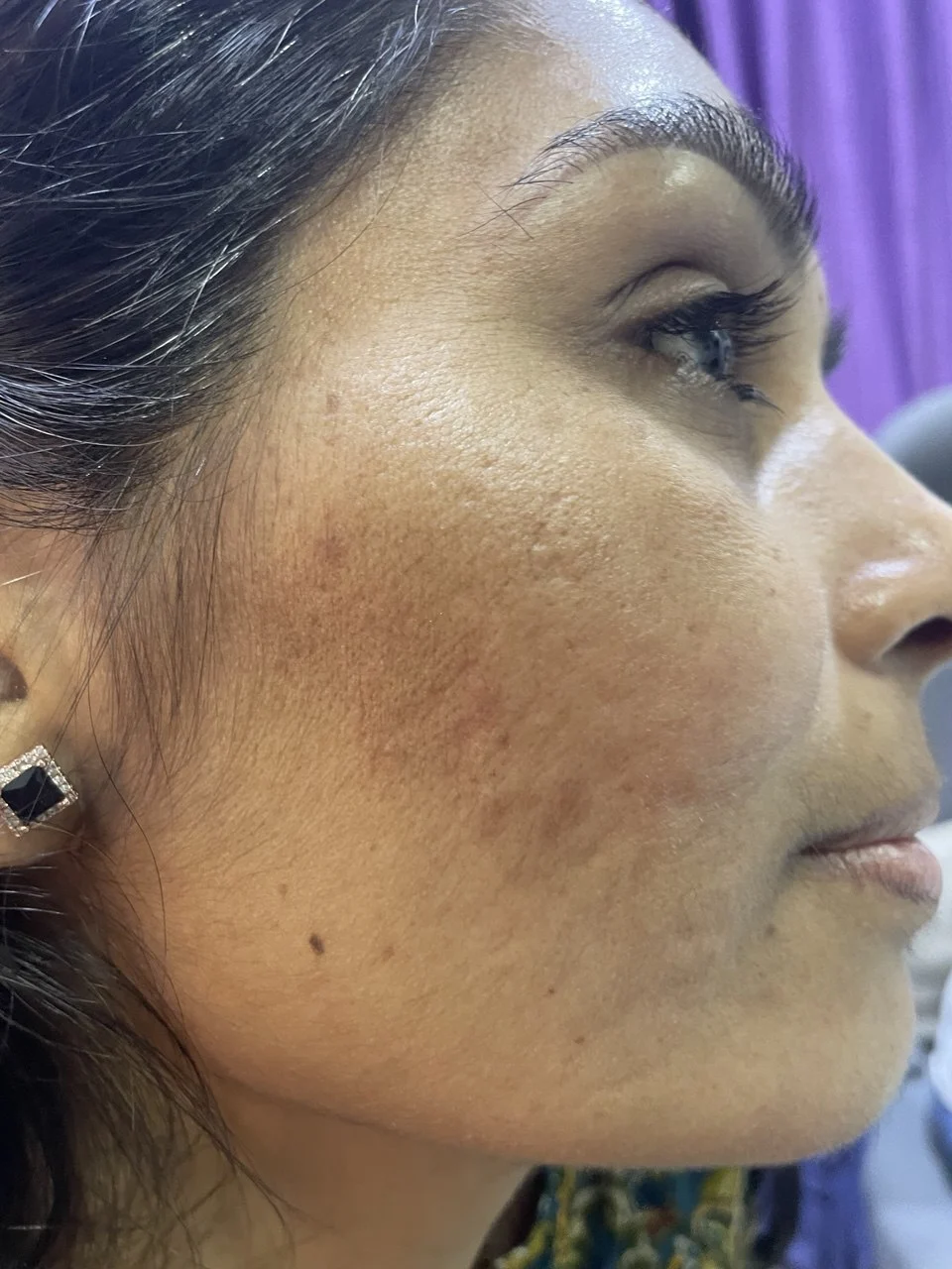 Laser Skin Resurfacing in London NW3 | Dermalogic