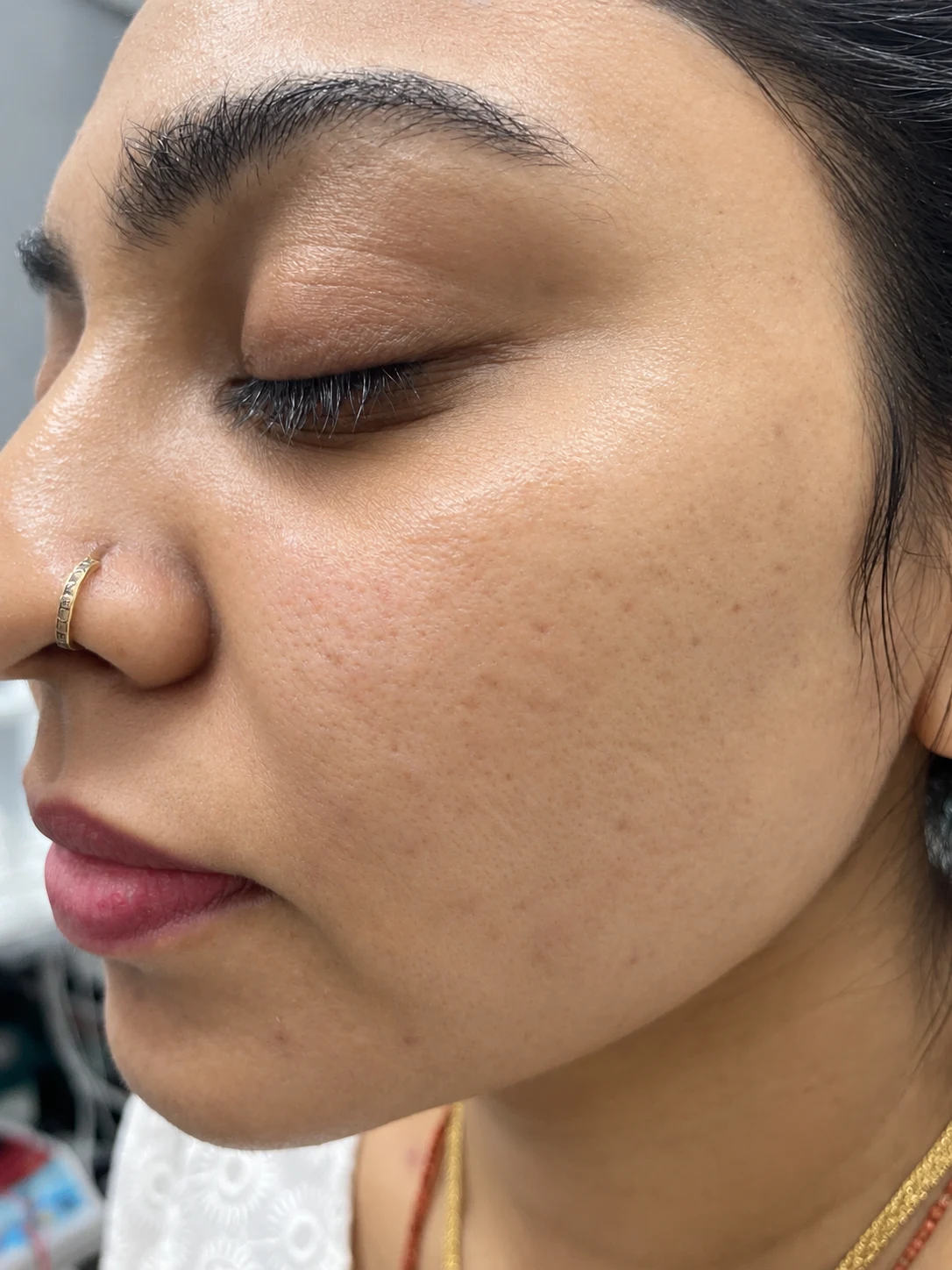 Laser Skin Resurfacing in London NW3 | Dermalogic