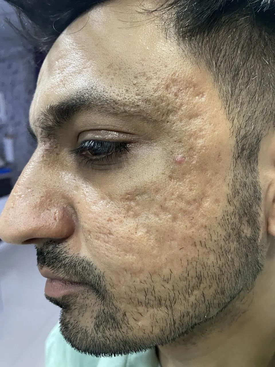 Laser Skin Resurfacing in London NW3 | Dermalogic