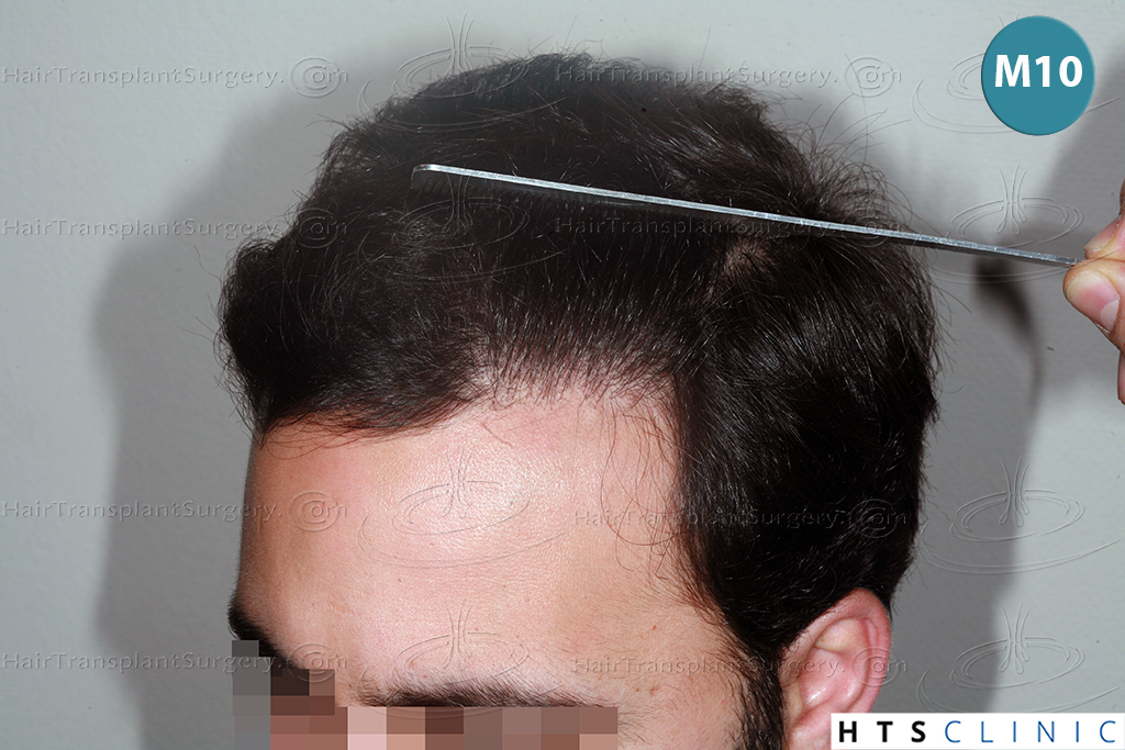 Dr._Devroye-HTS-clinic-3155-FUT-11_s1sbwf.jpg