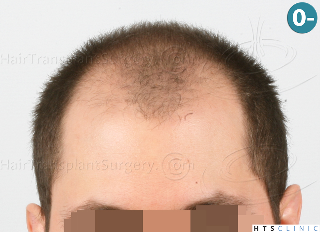 Dr.Devroye-HTS-clinic-3444-FUE-NW-V-1.jpg