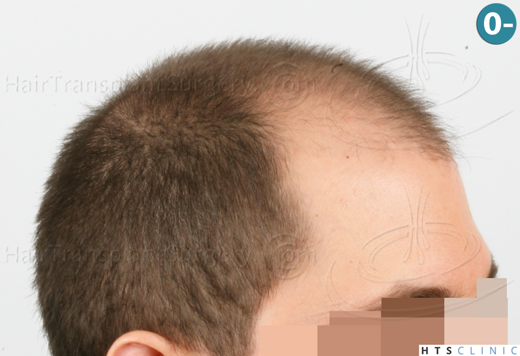 Dr.Devroye-HTS-clinic-3444-FUE-NW-V-4.jpg