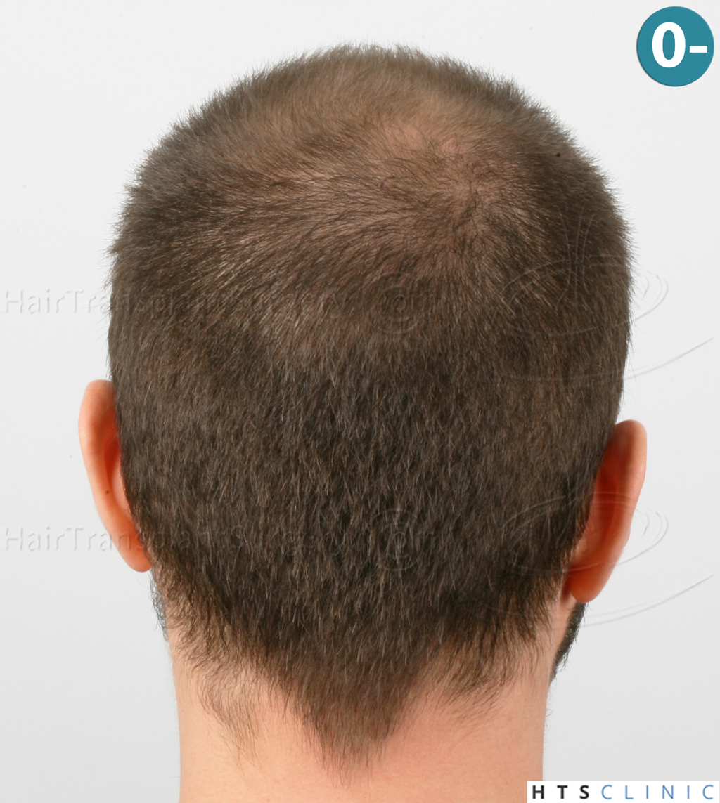 Dr.Devroye-HTS-clinic-3444-FUE-NW-V-5.jpg
