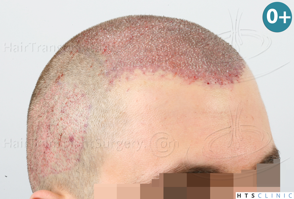 Dr.Devroye-HTS-clinic-3444-FUE-NW-V-10.jpg