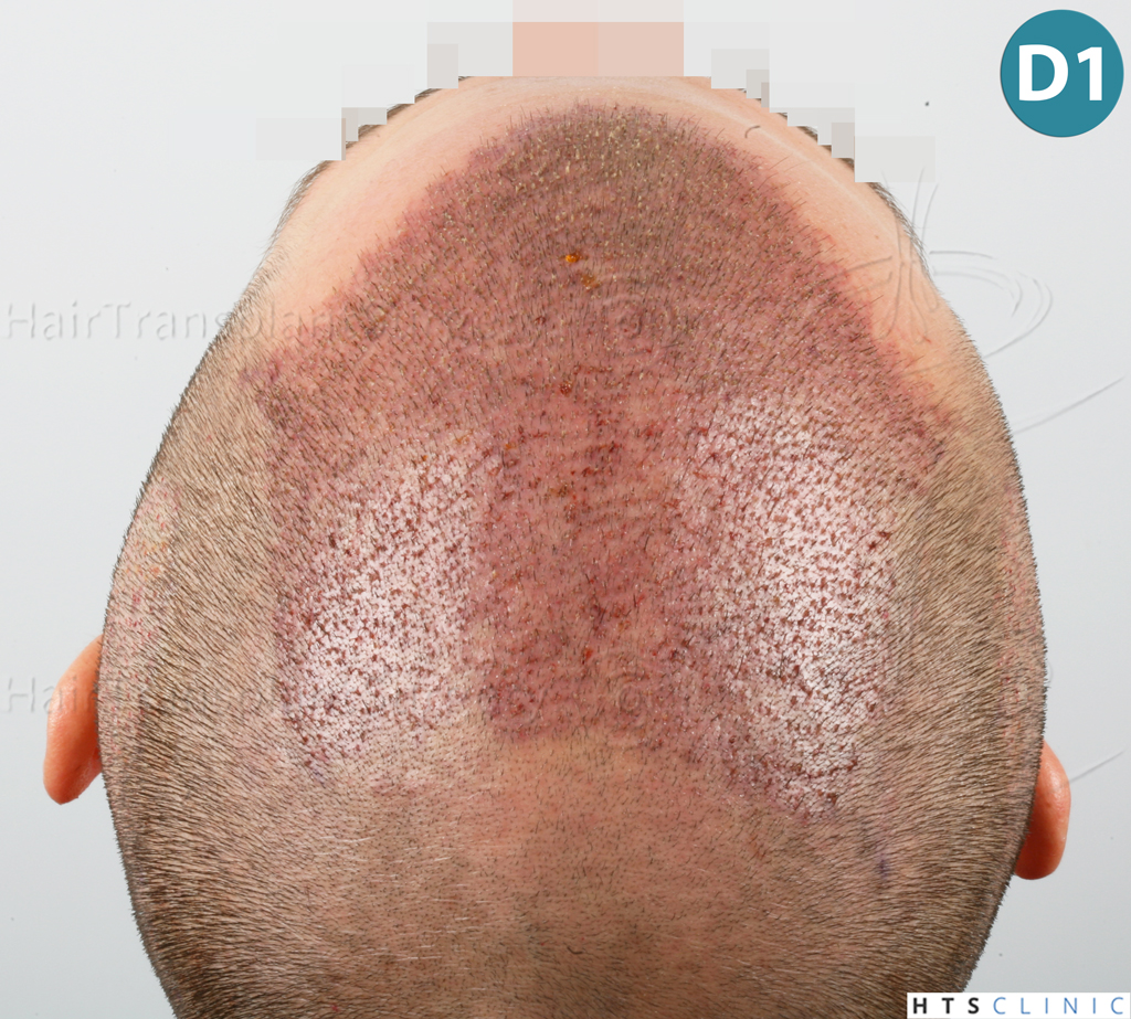 Dr.Devroye-HTS-clinic-3444-FUE-NW-V-12.jpg