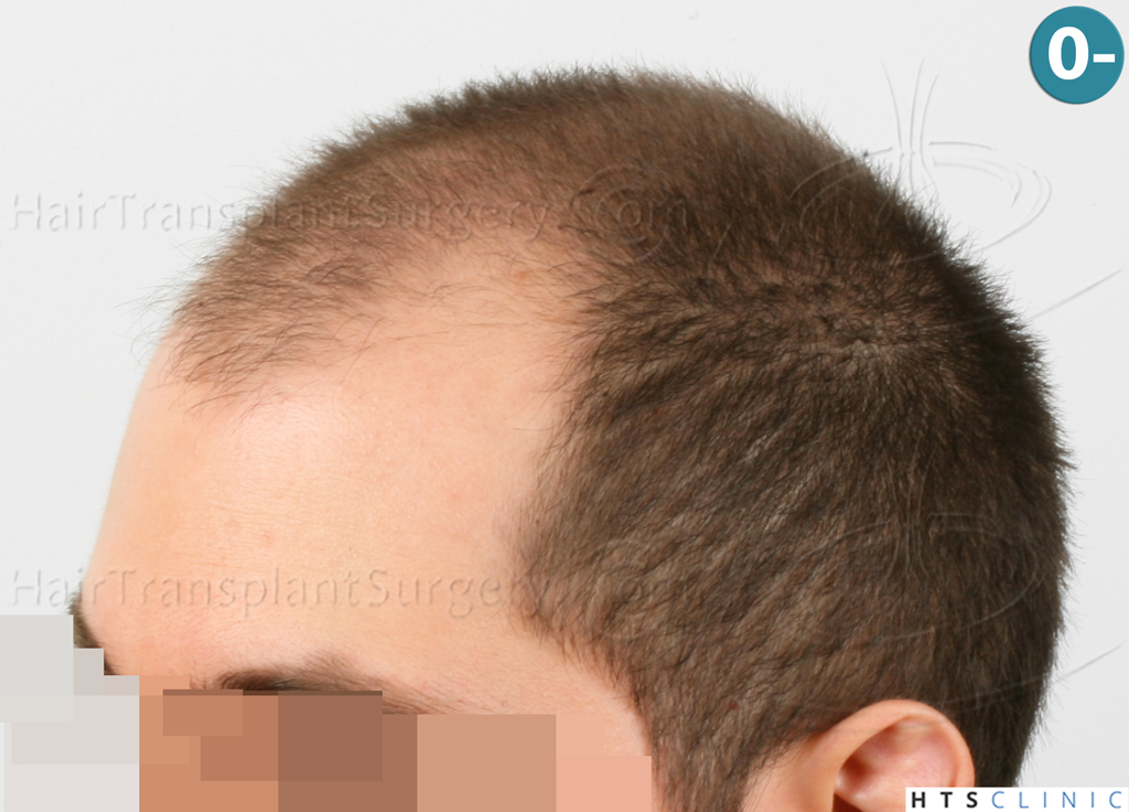 Dr.Devroye-HTS-clinic-3444-FUE-NW-V-3.jpg