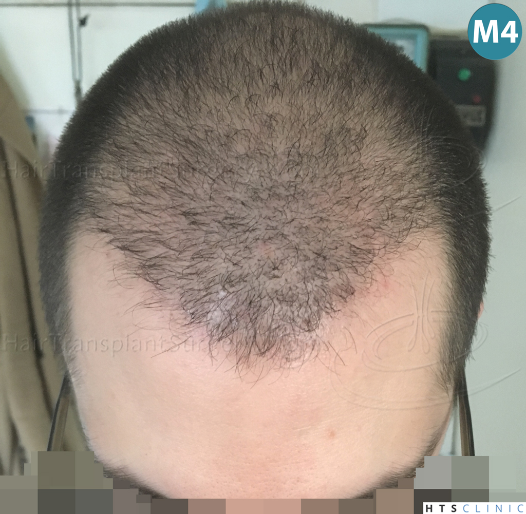Dr.Devroye-HTS-clinic-3444-FUE-NW-V-15.jpg