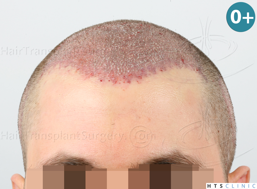 Dr.Devroye-HTS-clinic-3444-FUE-NW-V-7.jpg
