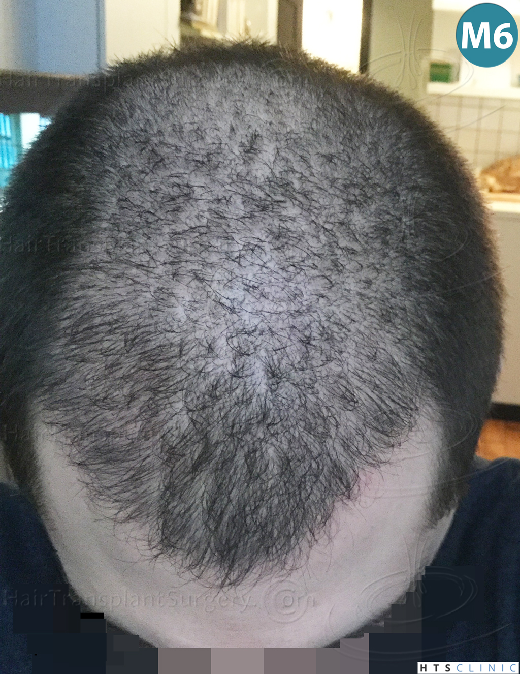 Dr.Devroye-HTS-clinic-3444-FUE-NW-V-18.jpg