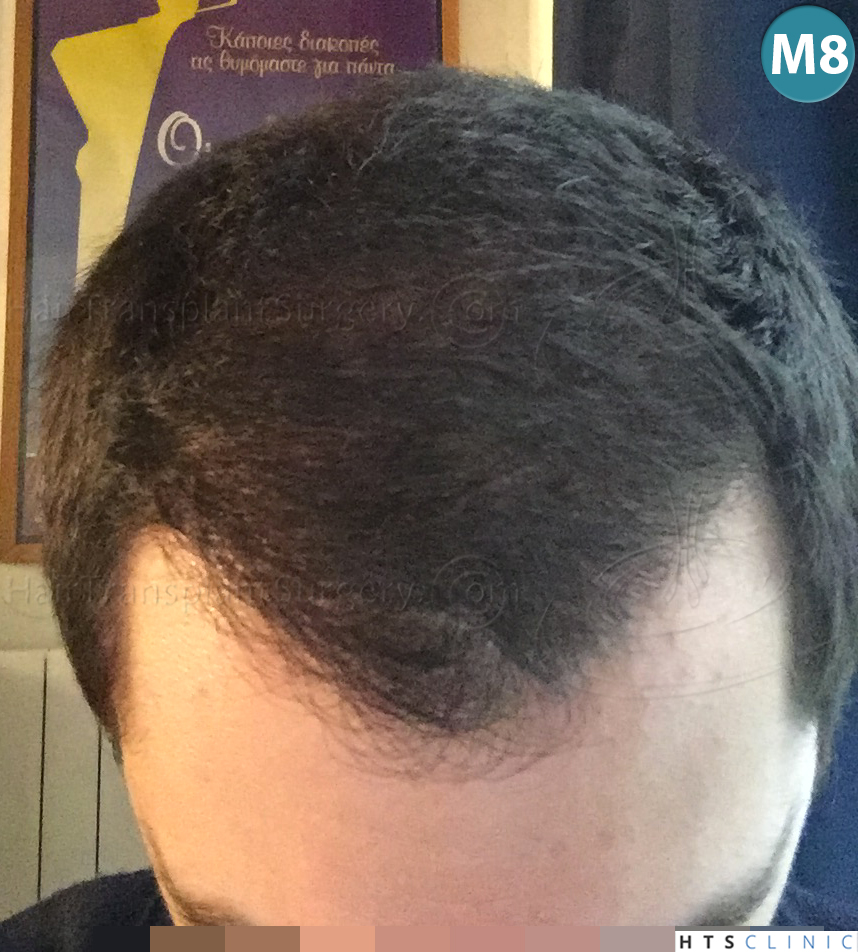 Dr.Devroye-HTS-clinic-3444-FUE-NW-V-23.jpg
