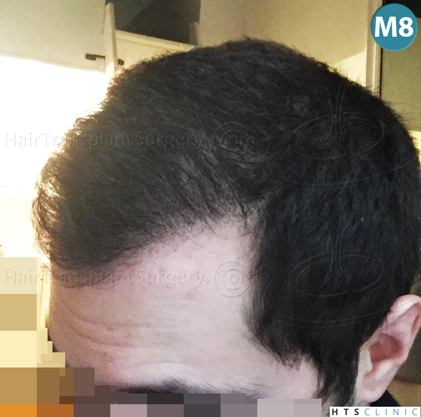 Dr.Devroye-HTS-clinic-3444-FUE-NW-V-26.jpg