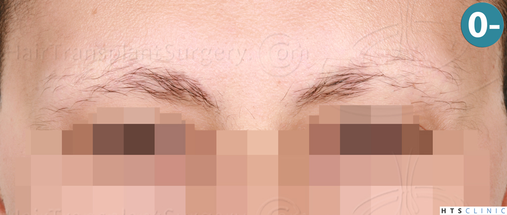 Dr.Devroye-HTS-Clinic-510-FUE-Eyebrows-1