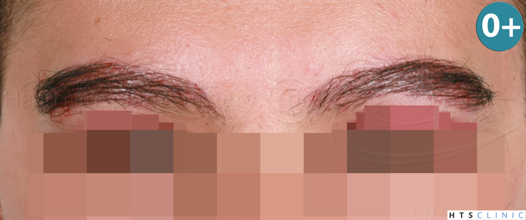 Dr.Devroye-HTS-Clinic-510-FUE-Eyebrows-4