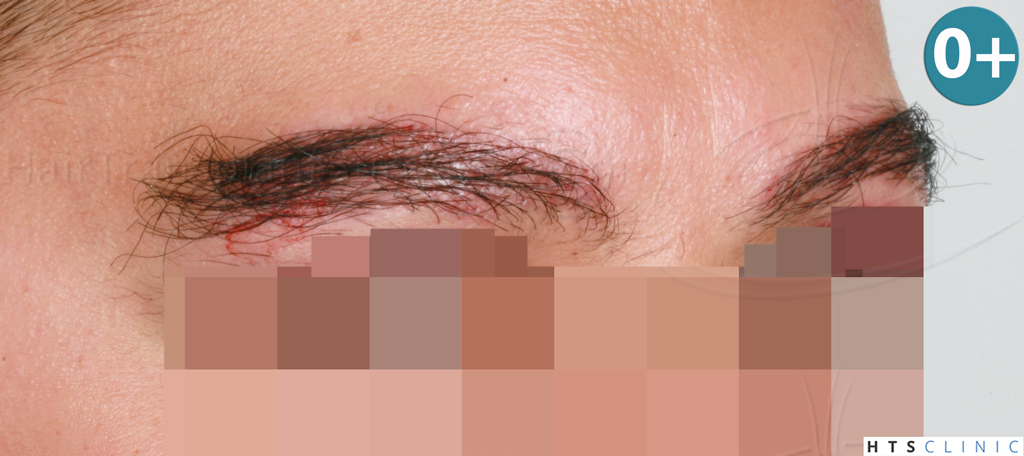 Dr.Devroye-HTS-Clinic-510-FUE-Eyebrows-6