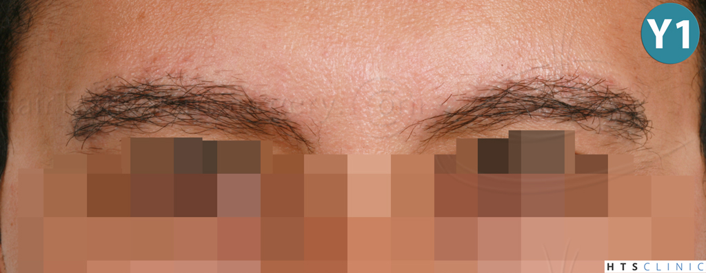 Dr.Devroye-HTS-Clinic-510-FUE-Eyebrows-1