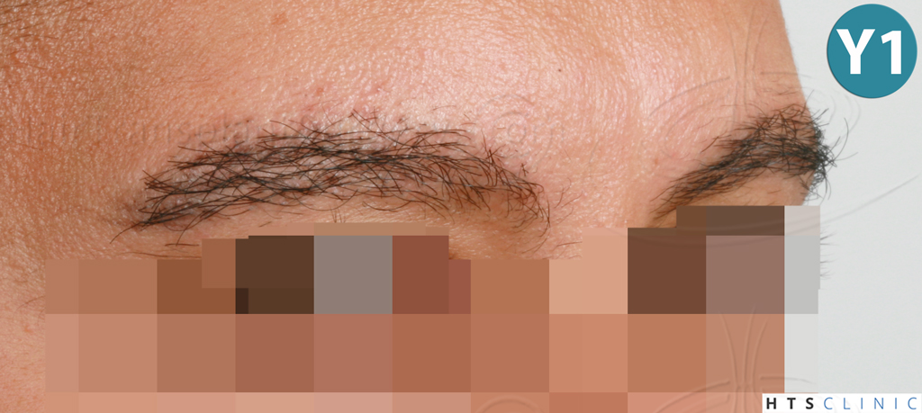 Dr.Devroye-HTS-Clinic-510-FUE-Eyebrows-16.jpg