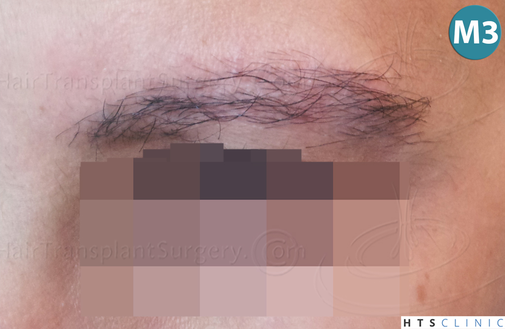 Dr.Devroye-HTS-Clinic-510-FUE-Eyebrows-9.jpg