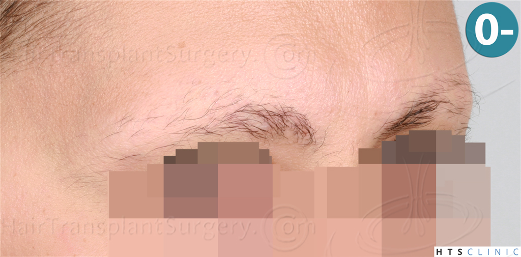 Dr.Devroye-HTS-Clinic-510-FUE-Eyebrows-3.jpg