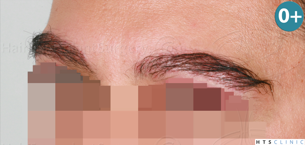 Dr.Devroye-HTS-Clinic-510-FUE-Eyebrows-5.jpg