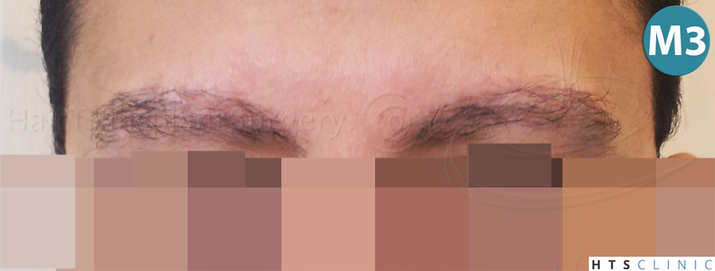 Dr.Devroye-HTS-Clinic-510-FUE-Eyebrows-8.jpg