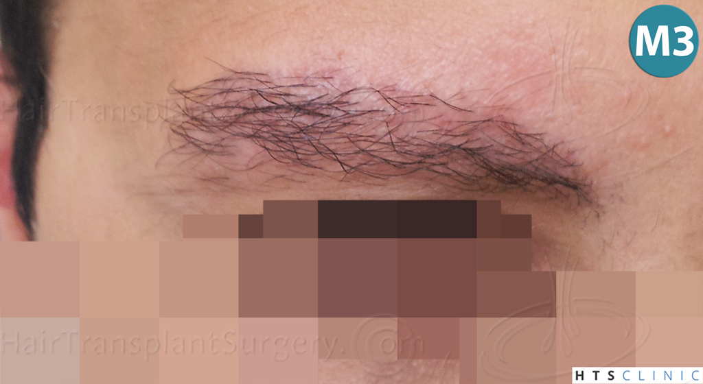 Dr.Devroye-HTS-Clinic-510-FUE-Eyebrows-10.jpg