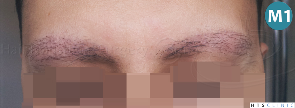 Dr.Devroye-HTS-Clinic-510-FUE-Eyebrows-7.jpg