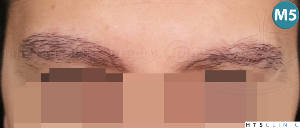 Dr.Devroye-HTS-Clinic-510-FUE-Eyebrows-1