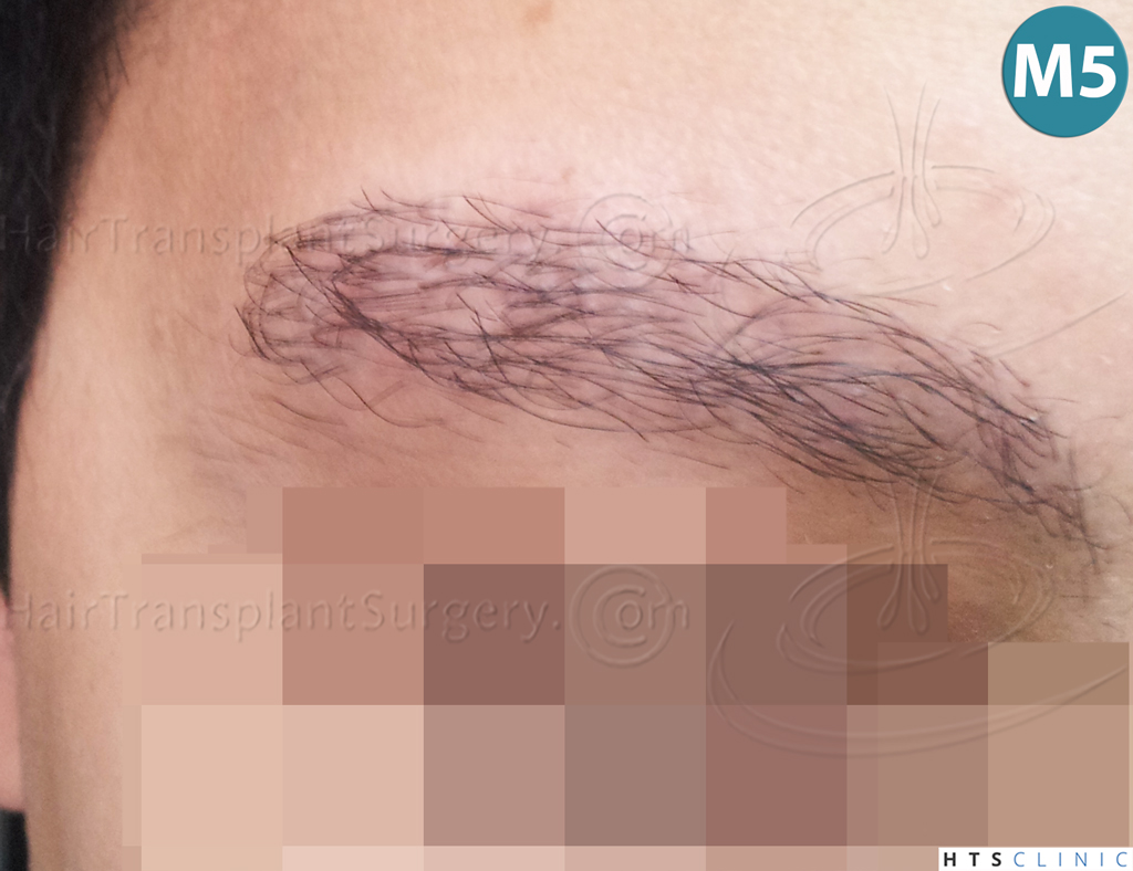 Dr.Devroye-HTS-Clinic-510-FUE-Eyebrows-1