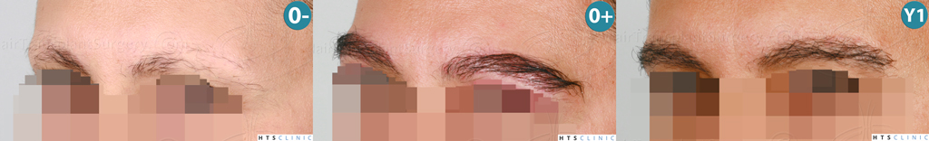 Dr.Devroye-HTS-Clinic-510-FUE-Eyebrows-Montage2.jpg