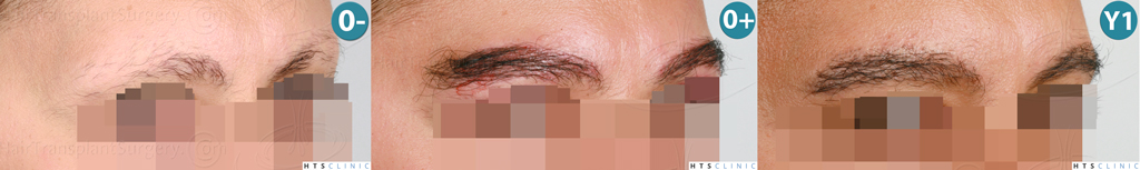 Dr.Devroye-HTS-Clinic-510-FUE-Eyebrows-M