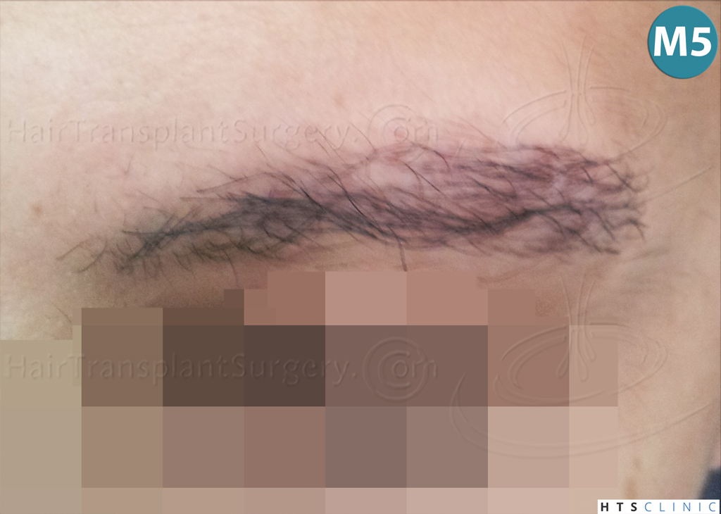 Dr.Devroye-HTS-Clinic-510-FUE-Eyebrows-12.jpg
