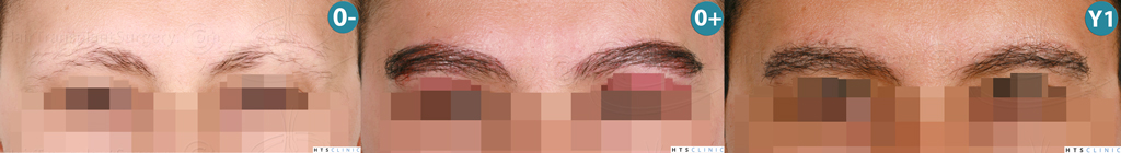 Dr.Devroye-HTS-Clinic-510-FUE-Eyebrows-Montage1.jpg