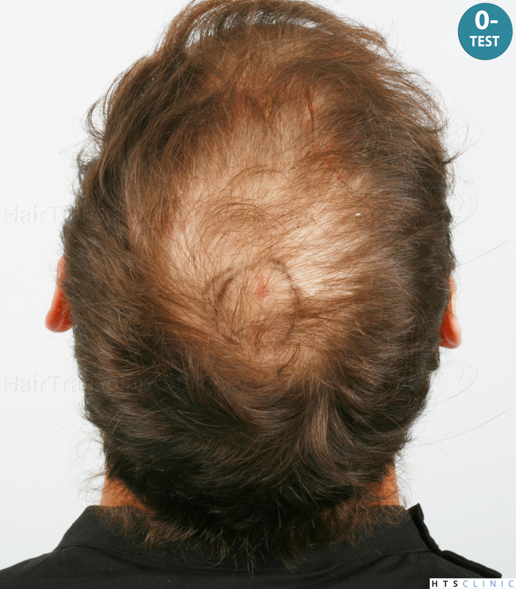 Dr.Devroye-HTS-Clinic-4418-FUE-Repair-4.jpg