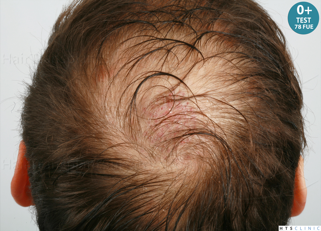 Dr.Devroye-HTS-Clinic-4418-FUE-Repair-6.jpg