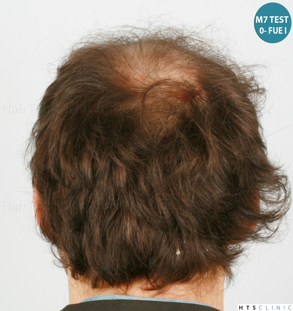 Dr.Devroye-HTS-Clinic-4418-FUE-Repair-11.jpg