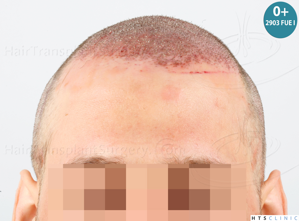 Dr.Devroye-HTS-Clinic-4418-FUE-Repair-13.jpg