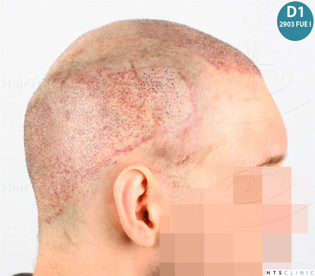 Dr.Devroye-HTS-Clinic-4418-FUE-Repair-17.jpg