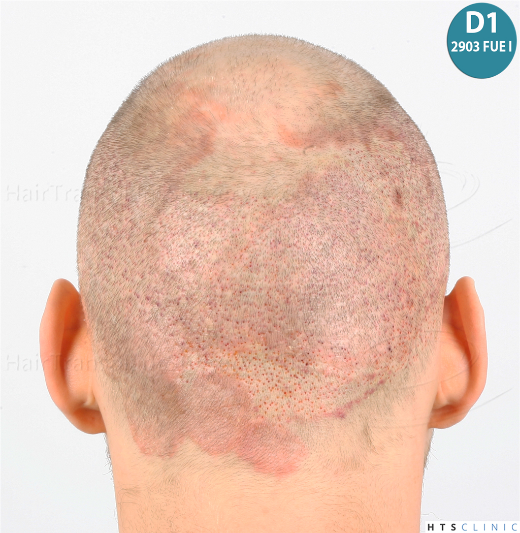 Dr.Devroye-HTS-Clinic-4418-FUE-Repair-18.jpg