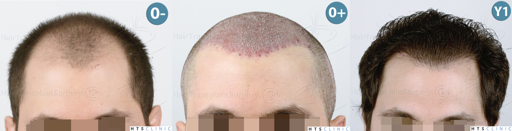 Dr.Devroye-HTS-clinic-3444-FUE-NW-V-Mont