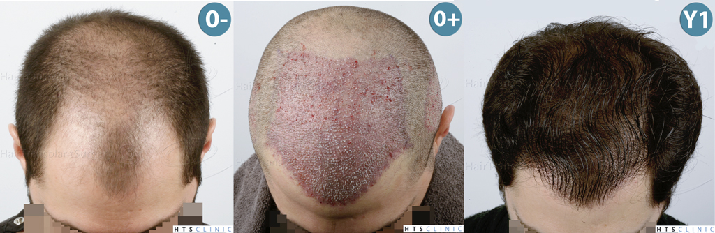 Dr.Devroye-HTS-clinic-3444-FUE-NW-V-Mont