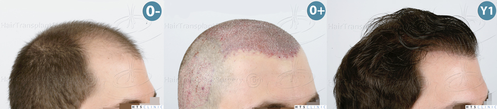 Dr.Devroye-HTS-clinic-3444-FUE-NW-V-Mont