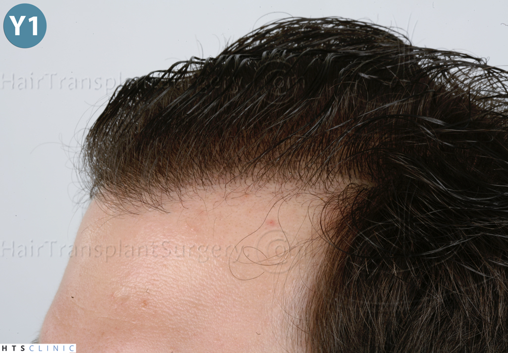 Dr.Devroye-HTS-clinic-3444-FUE-NW-V-33.jpg