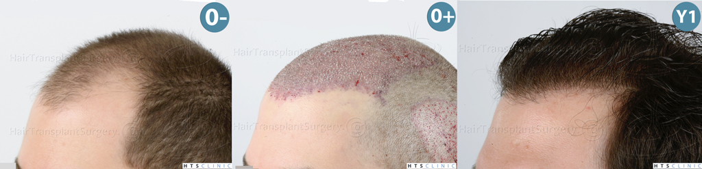 Dr.Devroye-HTS-clinic-3444-FUE-NW-V-Mont