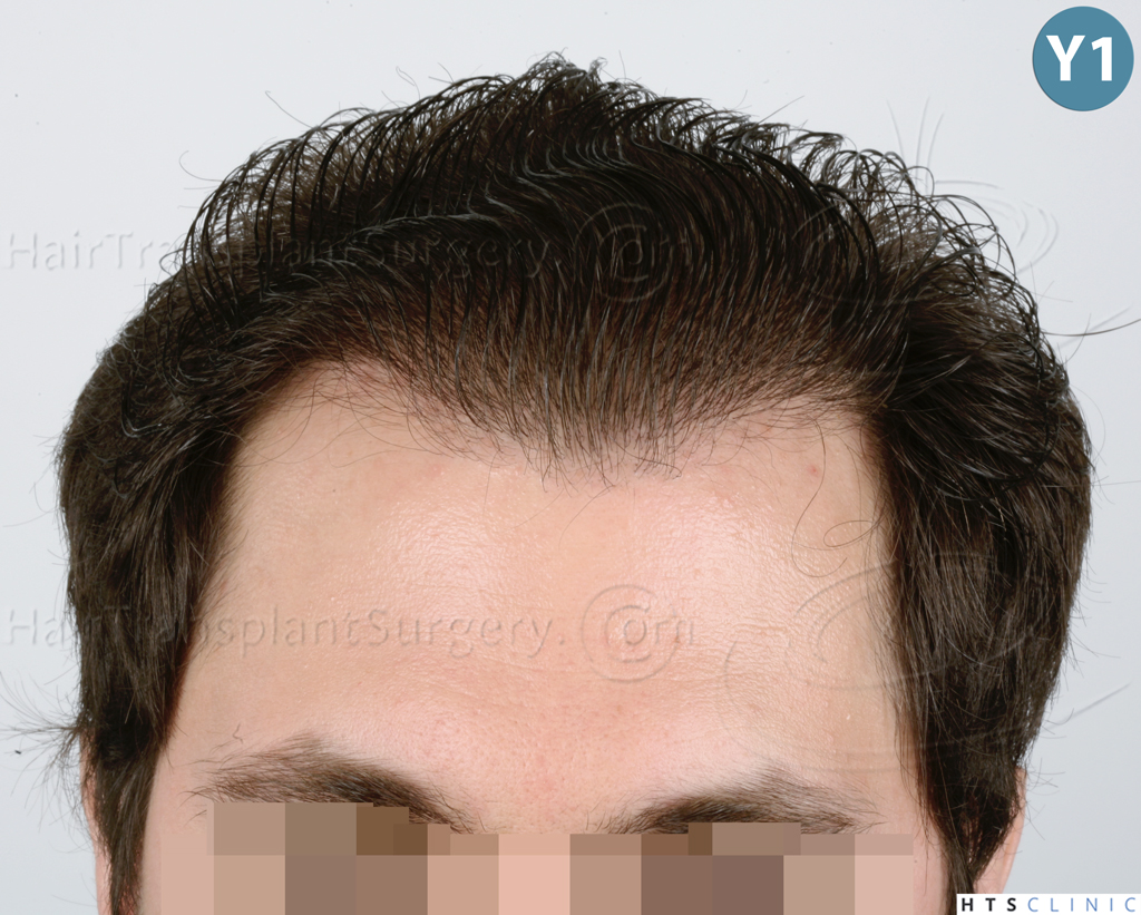 Dr.Devroye-HTS-clinic-3444-FUE-NW-V-31.j